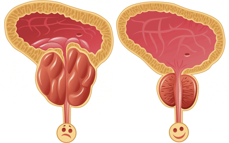 Shkaqet e problemeve të potencës tek meshkujt